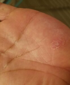 Compound W Dual Power for Large Warts, Freeze Off & Liquid Wart Remover, 8 Freeze Applications and 12 Comfort Pads 22 61O fNYrLL 4