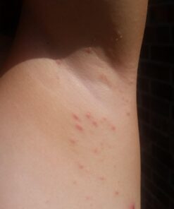 emuaid EMUAIDMAX Ointment 2oz - Eczema Cream. Maximum Strength Treatment. Use Max Strength for Athletes Foot, Psoriasis, Jock Itch, Anti Itch, Rash and Skin Yeast Infection. Standard Packaging 40 61Om tmbi7L