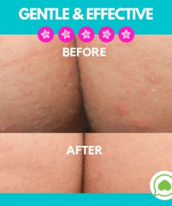 Green Heart Labs Butt Acne Clearing Lotion - Vegan & Cruelty-Free Treatment for Body, Back, Bum & Thigh - Clear Pimples, Bumps, Blackheads 4 Fl Oz (Pack of 1) 19 61PDU01 4L 1