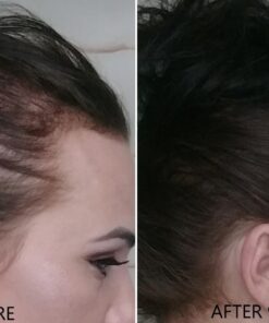 Haircore XL: DHT Blocker, Stops Hair Loss, Thinning, Balding, Repairs Hair Follicles, Promotes New Hair Growth, Regrow Hair, Men & Women, All Hair Types, 30 Day Supply 9 61QTnTewsdL