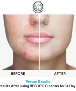 Beauty Facial Extreme Acne Gel Cleanser - 10% Benzoyl Peroxide, Fight Acne Blemishes on Contact for Cystic Breakouts, Oily Skin, Clogged Pores, Blackhead, Whitehead & Pimples. Achieve Clear Skin. 12 61U3vlPyzSL