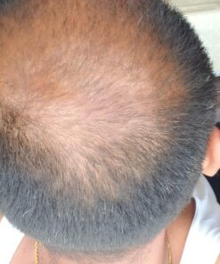 Men's Rogaine 5% Minoxidil Foam for Hair Loss and Hair Regrowth, Topical Treatment for Thinning Hair, 3-Month Supply, 2.11 Ounce (Pack of 3) Men's Rogaine Foam Treatment (3-Month Supply) 2.11 Ounce (Pack of 3) 57 61Vn0BX589L