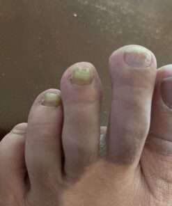 emuaid EMUAIDMAX Ointment 2oz - Eczema Cream. Maximum Strength Treatment. Use Max Strength for Athletes Foot, Psoriasis, Jock Itch, Anti Itch, Rash and Skin Yeast Infection. Standard Packaging 34 61WyZIjJwtL