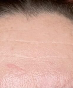 Frownies Forehead and Between Eyes Wrinkle Patches The Original Wrinkle Patch Non Invasive Wrinkle Smoothers for Forehead Wrinkles 48 61Y3A5487L