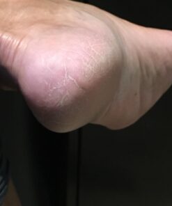 Amope Pedi Perfect Electronic Foot File, Dual-Speed Callus Remover (with Diamond Crystals) for Feet (Extra Coarse - Pink Gadget). -Perfect for In-home Pedicure for Baby Smooth Feet. Battery Operated 44 61a bw0l27L