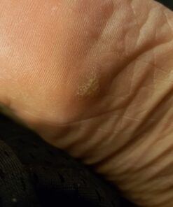 Compound W Wart Remover Maximum Strength One Step Pads, 14 Medicated Pads 14 Count (Pack of 1) 45 61aiXDNy6RL