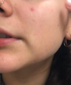 Tea Tree Essential Oil, 1 Fl Oz with Dropper - Undiluted Therapeutic Grade for Your Face, Skin, Hair and Diffuser - 100% Pure Melaleuca Oil for Acne, Toenails - by Pure Body Naturals 1 Fl Oz (Pack of 1) 35 61bmS9EURqL