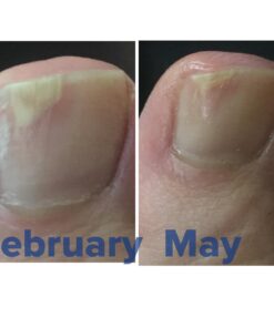 FungaBlend 10 - Antifungal Medication:1% Tolnaftate and 10 Plant Medicines -Toenail Fungus Treatment for Nail Repair Gel, Athletes Foot, Jock Itch, Ringworm -Topical Solution for Toe and Finger Nail 17 61eYc6pCBeL