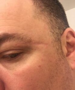 NewGel+E Advanced Silicone Scar Treatment Gel for OLD and NEW Scars w Vitamin E, for Surgery, Injury, Keloids, Burns, and Facial Blemish Scars (1 oz) 1 Ounce 23 61fZH8HNmQL