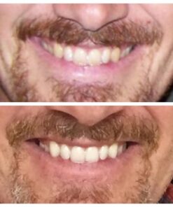 Opalescence 35% Gel Syringes Teeth Whitening - Refill Kit (4 Packs / 8 Count) Carbamide Peroxide. Made by Ultradent, in Cool Mint Flavor. Tooth Whitening Refill Syringes 5197-4 Mint 35 8 Count (Pack of 1) 21 61gYexkjWIL