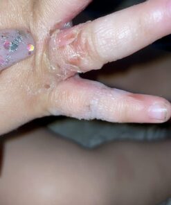 SilverSeal Burn and Wound Dressing | Hydrogel Pads with X-Static Silver | Soothing, Moist & Protective | Burns, Cuts & Wounds | 4 Sterile Dressings 4"x4" Patch (4 Count) 52 61h5L1wfwKL