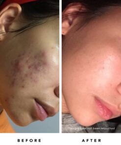 HERBIVORE Blue Tansy BHA & Enzyme Pore Refining Mask - Naturally Clarifies Acne, Blemishes & Redness, Vegan & Cruelty-Free, 60 mL / 2.02 oz 16 61ibS0QViUL