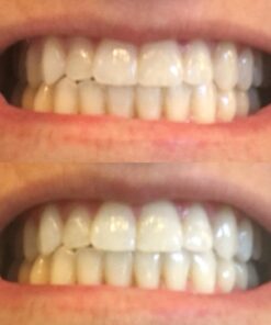 D.I.Y)10 Thermo-molding "BOIL and BITE" Mouth Trays by Instant White Smile Wholesale 7 61izhCIMcRL