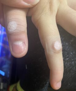 Compound W One Step Wart Remover Strips for Kids, 10 Medicated Strips for Wart Removal, 2 Pack unflavored 10 Count (Pack of 2) 38 61kZaP60kaL