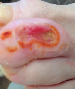 BerbereX Antimicrobial Wound Cleanser for Cuts, Scrapes, Burns, Incisions, Piercing Aftercare, Wounds, Wound Care, First Aid Antiseptic Antibacterial Spray, Pressure Sore, Diabetic Ulcer - 4oz 17 61mC67bMNaL