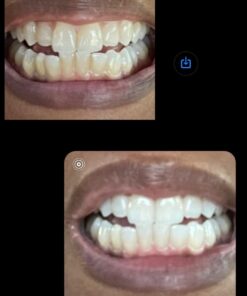 Opalescence 35% Gel Syringes Teeth Whitening - Refill Kit (2 Packs / 4 Count) Carbamide Peroxide. Made by Ultradent, in Cool Mint Flavor. Tooth Whitening Refill Syringes 5197-2 Mint 35 4 Count (Pack of 1) 29 61ms2gDRM0L