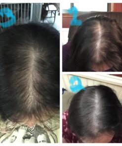 iRestore Essential Laser Hair Growth System - FDA Cleared Hair Loss Treatments for Men & Women & Hair Growth Products for Men with Thinning Hair, Hair Regrowth Treatments Laser Cap, Red Light Therapy 55 61nC75YmKfL