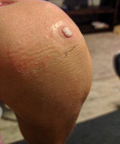 Compound W One Step Wart Remover Strips for Kids, 10 Medicated Strips for Wart Removal, 2 Pack unflavored 10 Count (Pack of 2) 50 61ndGengc1L