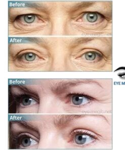 Eye Magic Original Eye Lift Kit (Small/Medium Size With Gel) Lifts Eyelid Droop and Hooded Eyes | Open And Show Off Your Beautiful Eyes | Made In America 11 61oFgyrg10L