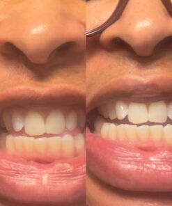 Opalescence 35% Gel Syringes Teeth Whitening - Refill Kit (2 Packs / 4 Count) Carbamide Peroxide. Made by Ultradent, in Cool Mint Flavor. Tooth Whitening Refill Syringes 5197-2 Mint 35 4 Count (Pack of 1) 28 61odieyIRxL