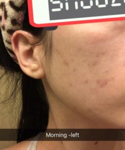 Ebanel Acne Drying Lotion, Overnight Salicylic Acid and Sulfur Cystic Acne Spot Treatment for Face and Body, Pimple Cream Spot Treatment, Dries Out Pimples, Cysts, Blemishes, Zits, and Clogged Pores 33 61rQsvxTBxL