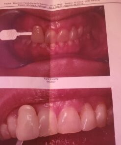 Opalescence 35% Gel Syringes Teeth Whitening - Refill Kit (4 Packs / 8 Count) Carbamide Peroxide. Made by Ultradent, in Cool Mint Flavor. Tooth Whitening Refill Syringes 5197-4 Mint 35 8 Count (Pack of 1) 20 61s ZTgz0NL