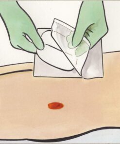 Medline Exuderm Odorshield Hydrocolloid Wound Dressing, 2" x 2" (Pack of 10) 15 61s9r2kK7jL