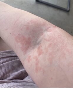 Tea Tree Oil Balm , Extra Strength, Pair Well with Jock Itch Cream, Spray, Athletes Foot, Ringworm Cream for Human, Fast Acting for Dry, Itchy Skin, Plant Powered Wonder Balm 41 61sCxUh PcL