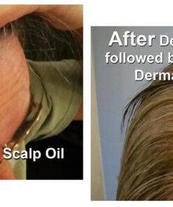 Dermasolve 4 oz Psoriasis, Seborrheic Dermatitis, & Dandruff Scalp Oil 2 Pack | Dermatologist Approved | Flaky Scalp Relief | Clinically Tested, Long-Lasting Itch-Free, High-Performance Formula 4 Ounce (Pack of 2) 22 61sHo3uCYgL