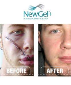 NewGel+E Advanced Silicone Scar Treatment Gel for OLD and NEW Scars w Vitamin E, for Surgery, Injury, Keloids, Burns, and Facial Blemish Scars (1 oz) 1 Ounce 20 61t237UumTL