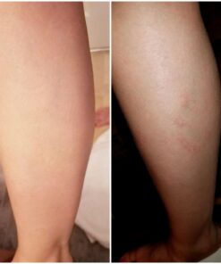 Eczema Cream for Adults & Kids - Eczema Psoriasis & Rosacea Care Cream for Dry Itchy Skin Relief - Face Body & Hand Eczema Moisturizer - Eczema Relief & Seborrheic Dermatitis Cream for Face 4 Ounce (Pack of 1) 38 61uvp6WmEmL 1