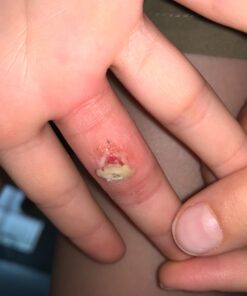 Compound W One Step Wart Remover Strips for Kids, 10 Medicated Strips for Wart Removal, 2 Pack unflavored 10 Count (Pack of 2) 47 61vD4Zmw 7L