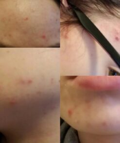 Acne Vitamins & Acne Supplements for Acne Treatment - Acne Pills & Acne Vitamin Supplements for Cystic Acne Treatment - Face, Back, Body & Hormonal Acne Treatment for Teens, Women & Men - 90 Pills 1 21 61w9RhUqhL