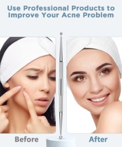 Alternative view of TAYTHI Blackhead Remover Tool, Pimple Popper Tool Kit, Blackhead Extractor Tool for Face, Extractor Tool for Comedone Zit Acne Whitehead Blemish, Stainless Steel Extraction Tools Silver 5 Piece Set