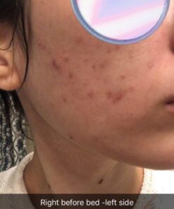 Ebanel Acne Drying Lotion, Overnight Salicylic Acid and Sulfur Cystic Acne Spot Treatment for Face and Body, Pimple Cream Spot Treatment, Dries Out Pimples, Cysts, Blemishes, Zits, and Clogged Pores 34 61yrc5BmYzL