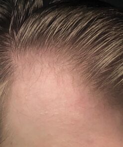 DHT BLOCKER - Hair Growth Supplement for Genetic Thinning for Men and Women | Approved* by American Hair Loss Association | Guaranteed, Backed by 20 Years of Experience in Hair Loss Treatment Clinics 62 71 IcluMuTL