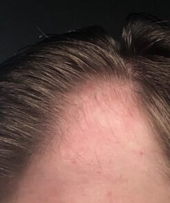 DHT BLOCKER - Hair Growth Supplement for Genetic Thinning for Men and Women | Approved* by American Hair Loss Association | Guaranteed, Backed by 20 Years of Experience in Hair Loss Treatment Clinics 63 71 MGjsBKbL