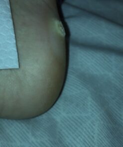 Compound W Maximum Strength One Step Plantar Wart Remover Foot Pads, 20 Count 20 Count (Pack of 1) 57 71 sre GcWL