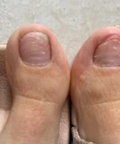 Toenail Renewal Solution Extra Strength Care for Toe Nail & Fingernails - Nail Repair Solution for Thick, broken, Discolored Nails - Renews Damaged Cracked Ingrown Toenail - Tea Tree Oil for Healthier and Extra Strength Nails - Made In USA 0.50 Fl Oz 48 7112uDSrXL