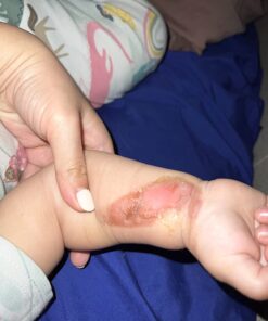 DuoDERM Extra Thin CGF Hydrocolloid 4"x4" Sterile Self-Adhesive Dressing for Management of Lightly Exuding Wounds, Flexible, Latex-Free, Beige, 187955, Box of 10 4x4 Inch (Pack of 10) 13 7115M57JwfL