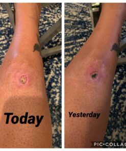 Terrasil Wound Care - 3X Faster Healing, Infection Protection for Bed sores, Pressure sores, Diabetic Wounds, Foot, Leg ulcers, cuts, scrapes, Burns - 50gm Tube 24 712rSQEjH8L