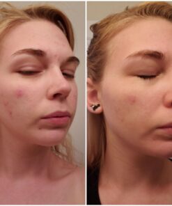 Tea Tree Essential Oil, 1 Fl Oz with Dropper - Undiluted Therapeutic Grade for Your Face, Skin, Hair and Diffuser - 100% Pure Melaleuca Oil for Acne, Toenails - by Pure Body Naturals 1 Fl Oz (Pack of 1) 42 713RMW z09L