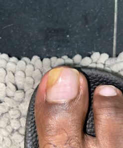 emuaid EMUAIDMAX Ointment 2oz - Eczema Cream. Maximum Strength Treatment. Use Max Strength for Athletes Foot, Psoriasis, Jock Itch, Anti Itch, Rash and Skin Yeast Infection. Standard Packaging 44 7146NNx5enL