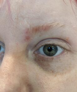 Nexcare Acne Cover, Skin Cover Absorbs Pus and Oil From Clogged Pores, Suitable Skincare for Most Skin Types - 36 Acne Covers 36 Count (Pack of 1) 43 714ESibRpTL