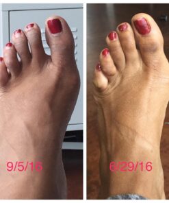 Original YogaToes - Small Sapphire Blue: Toe Stretcher & Toe Separator. Fight Bunions, Hammer Toes, Foot Pain & More! Small (Pack of 1) 35 714X g2xM7L 1