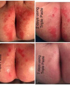 Triple Paste Diaper Rash Cream for Baby - 16 Oz Tub - Zinc Oxide Ointment Treats, Soothes and Prevents Diaper Rash - Pediatrician-Recommended Hypoallergenic Formula with Soothing Botanicals 16 Ounce 41 714YfifkCJL