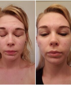 Tea Tree Essential Oil, 1 Fl Oz with Dropper - Undiluted Therapeutic Grade for Your Face, Skin, Hair and Diffuser - 100% Pure Melaleuca Oil for Acne, Toenails - by Pure Body Naturals 1 Fl Oz (Pack of 1) 43 716AX05rbL