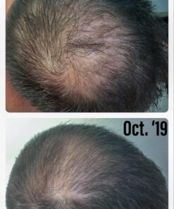 Growth Treatment Unscented 5% (Foam) 2 Ounce (Pack of 1) 20 7186zsIeTxL