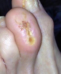 BerbereX Antimicrobial Wound Cleanser for Cuts, Scrapes, Burns, Incisions, Piercing Aftercare, Wounds, Wound Care, First Aid Antiseptic Antibacterial Spray, Pressure Sore, Diabetic Ulcer - 4oz 18 718COcGsXpL