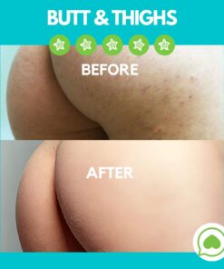 Green Heart Labs Butt Acne Clearing Lotion - Vegan & Cruelty-Free Treatment for Body, Back, Bum & Thigh - Clear Pimples, Bumps, Blackheads 4 Fl Oz (Pack of 1) 20 7190LtmdWfL